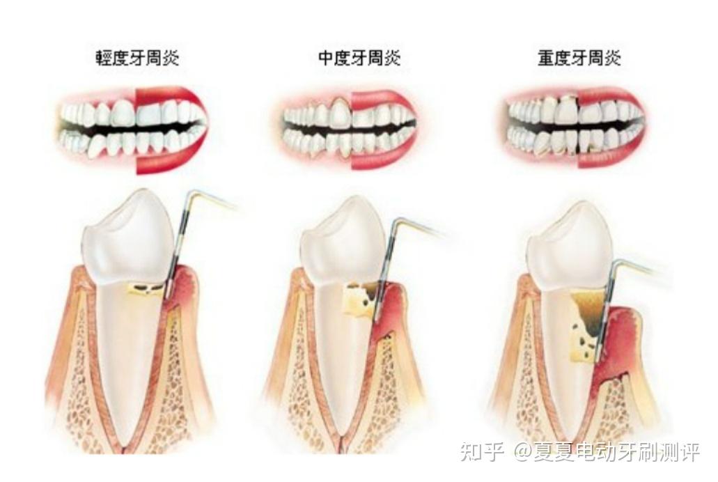 最新矢牙修复技术，重塑牙齿美丽的革命性进展